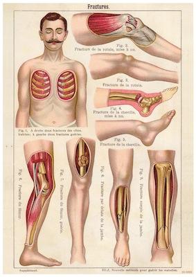 Fractures Small - A3 Posters